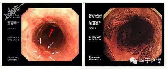 6个精彩病例带你领略早期食管癌的内镜下诊治