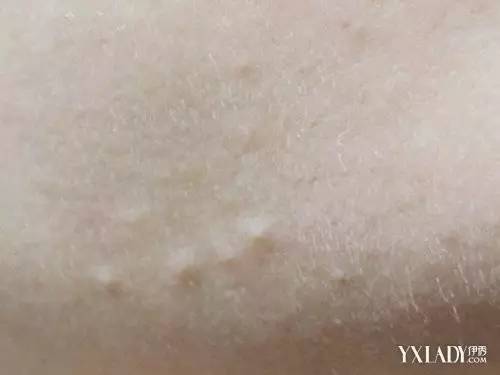 闭口什么样才是快好了,额头长闭口反反复复总是好不了