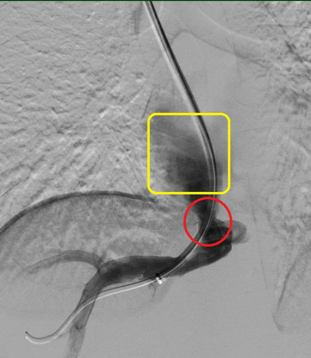 疑难病例|介入血管外科顺利开展布-加综合征的腔内治疗