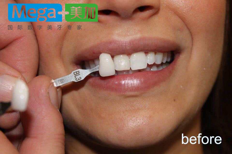 明星是怎么美白牙齿的,明星推荐牙齿美白最好的方法