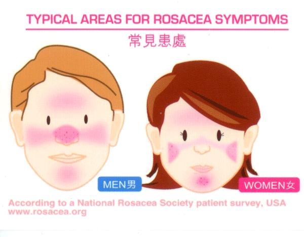 本以为脸部皮肤易发红是因为敏感，到医院检查后，却被诊为这种病