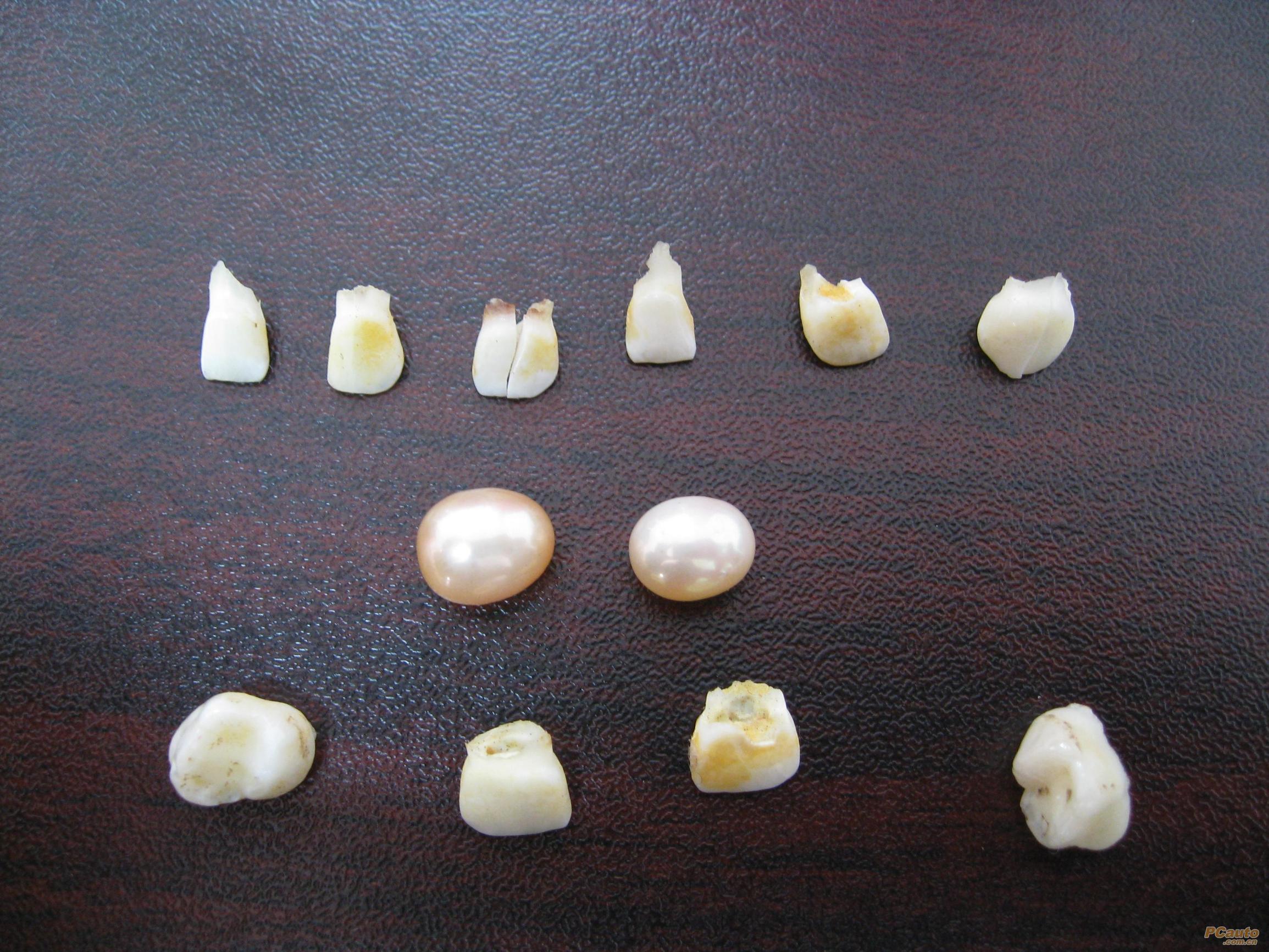 不小心误吃了耳屎会变哑巴吗,吃1年多的耳屎会变成哑巴吗