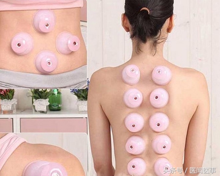 拔火罐拔出来的水泡真的是湿气吗,拔火罐拔出的湿气是肉湿还是外湿