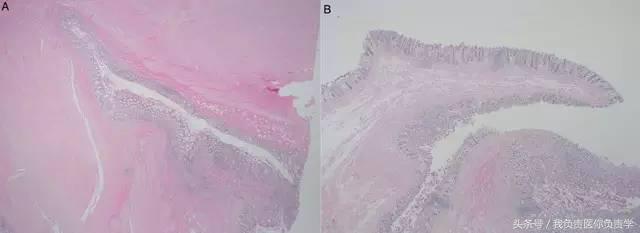 管状性结肠息肉,结肠多发息肉病例讨论