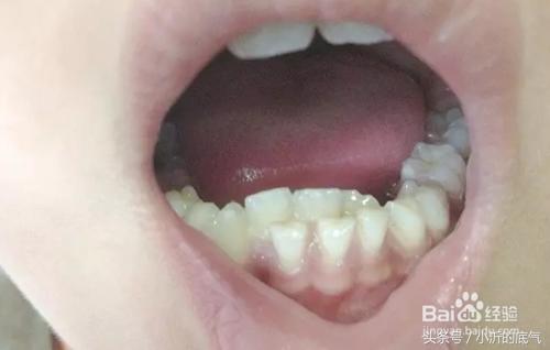 为什么乳牙残根一定要拔掉？一定不能留！