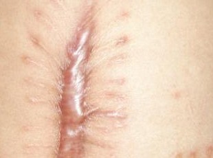 手术缝针疤痕怎么去除,嘴角缝针疤痕去除最佳时间