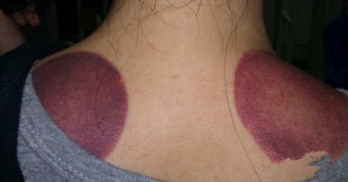 根据拔罐后皮肤的颜色鉴定你的身体到底是怎么了