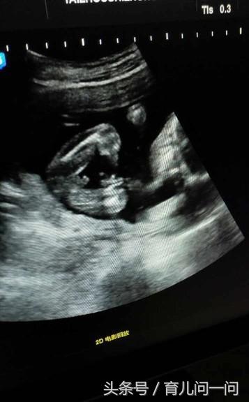 二胎b超显示三胞胎,b超一胎二胎小孩不一样