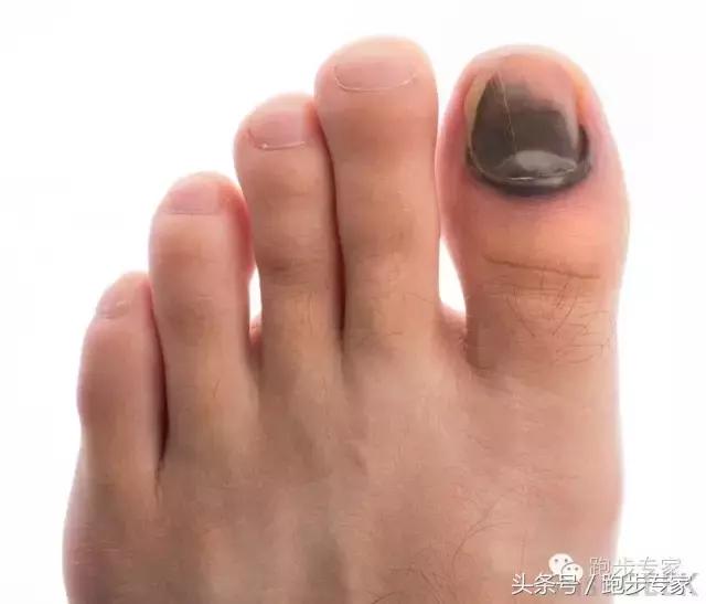 治疗灰指甲的偏方,有没有治灰指甲小妙招