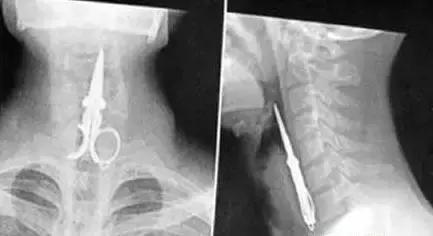 X光片里的体内异物，简直大开眼界