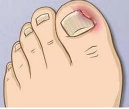 神奇的嵌甲,巨大隐藏嵌甲