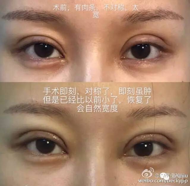 双眼皮变脸真实案例,网红双眼皮最成功的