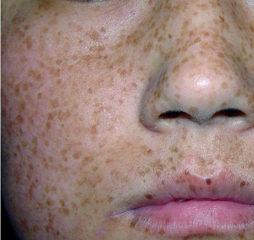 皮秒激光祛斑的副作用,激光c6祛斑副作用