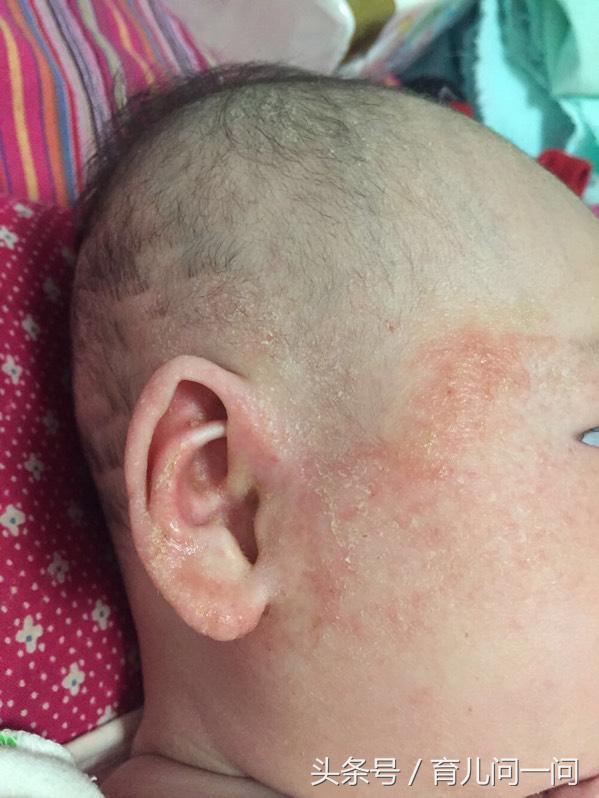 现在的宝宝为什么大多数长湿疹,宝宝从出生到一岁身上有干性湿疹