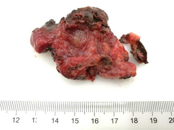 海绵窦海绵状血管瘤,海绵窦区海绵状血管瘤发病年龄