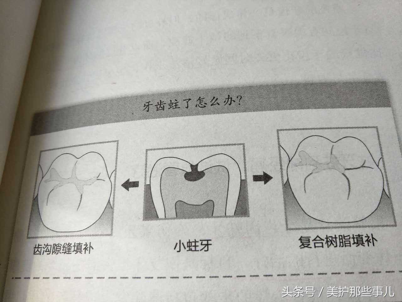 蛀牙怎么知道龋坏到牙神经了,蛀牙痛到神经怎么办