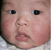 儿童当心哪些皮肤病,所有的皮肤病都有这些表现