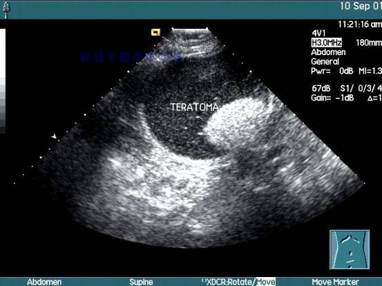 孕妈妈怀孕后，每次去医院做超声波检测时医生到底看什么