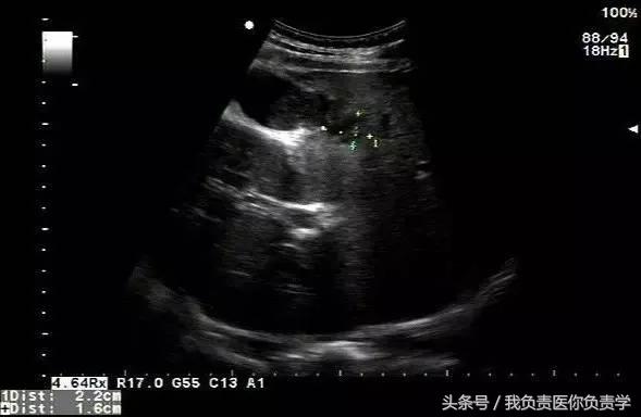 楂樻墜杩涢樁鑵拌吂璁粌,鑳嗗泭缁撶煶绌垮瓟鐥囩姸