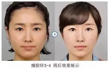 瘦脸针一个月没效果多久才能补打,瘦脸针打完多久能达到最佳效果