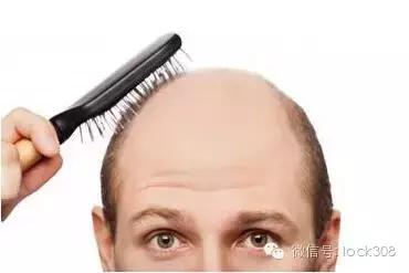 头顶稀疏发缝宽脂溢性脱发怎么办,前额头顶脱发稀疏细软怎样办