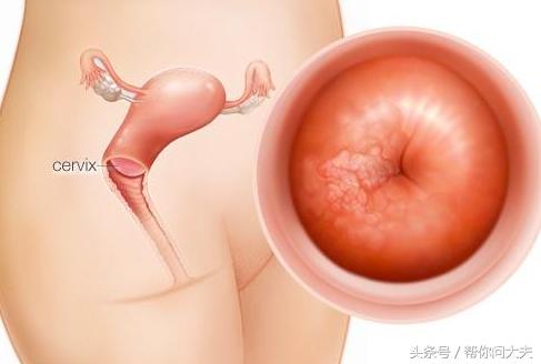 社区宫颈癌筛查和医院筛查的区别,一年前宫颈癌筛查一年后会变癌吗