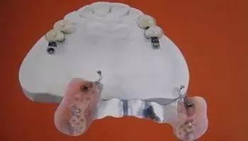 牙科镶牙全过程,口腔科普镶牙全过程图