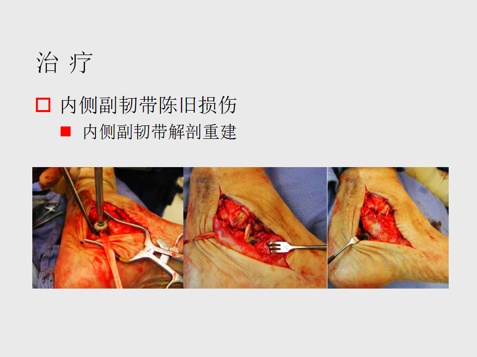 脚崴了怎么办判断是否骨折,脚崴了怎么办视频