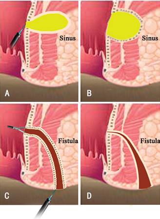 克罗恩病内镜严重程度指数,克罗恩病内镜检查是怎么样的