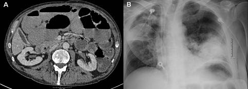 克罗恩病内镜严重程度指数,克罗恩病内镜检查是怎么样的