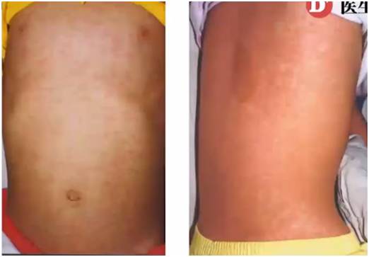 诊断麻疹最快速的方法,麻疹怎么做检测