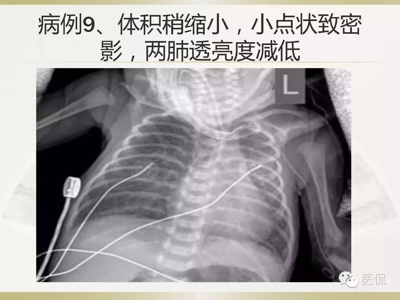 「资料丨医看分享」南边老师肺部群：新生儿透明膜病（HMD）医学影像