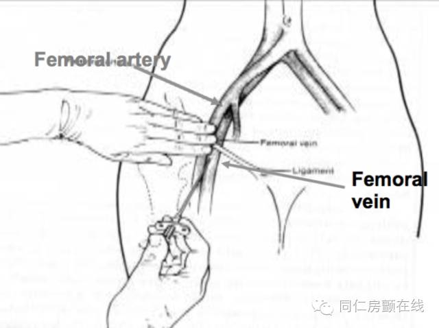 射频消融手术治房颤,房颤的射频消融术指南解读