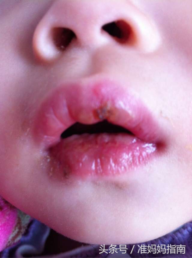 调理儿童口腔溃疡食谱,科学治疗口腔溃疡