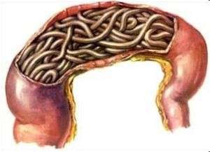 男子腹痛难忍医生实施手术,男子长期腹痛检查出虫子