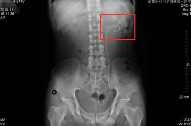 肾结石治疗最佳方案钬激光碎石,治疗肾结石案例