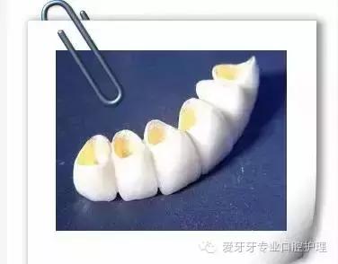 不同价格的牙冠区别在哪里,不同价格的烤瓷有区别吗