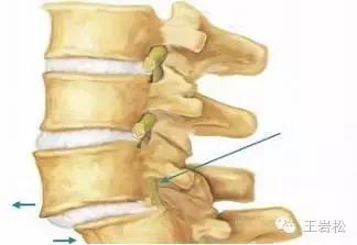 腰椎退行性变引起腰痛怎么治疗,腰椎退行性疾病怎么理疗