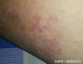 大腿根部出现红斑有点痒怎么回事,大腿根部起红斑用什么药