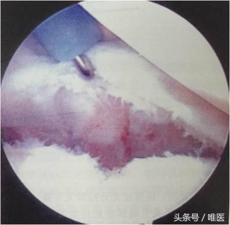 肩关节镜修复方法,肩关节镜下半骨道修复技术