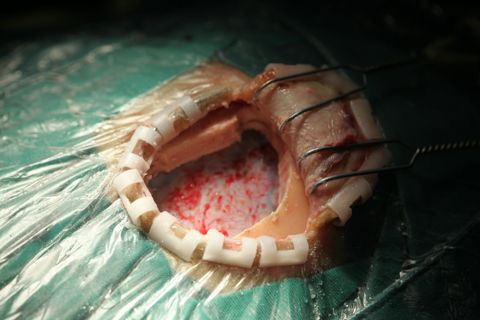 神经外科纪实视频,显微神经外科手术费用