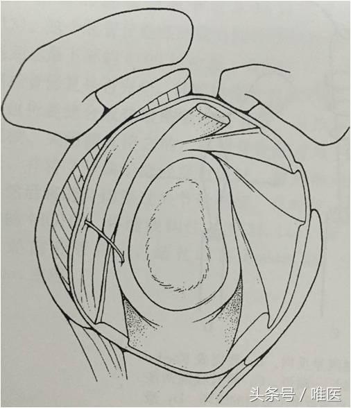肩关节镜修复方法,肩关节镜下半骨道修复技术