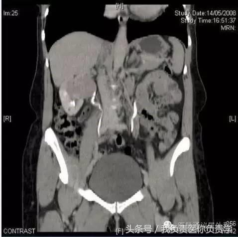 57岁女性出现一次无痛血尿,女性42岁全程无痛性肉眼血尿