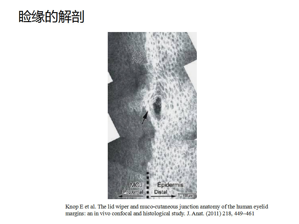 眼睑缘炎的发病原因,眼睑炎的症状和治疗方法