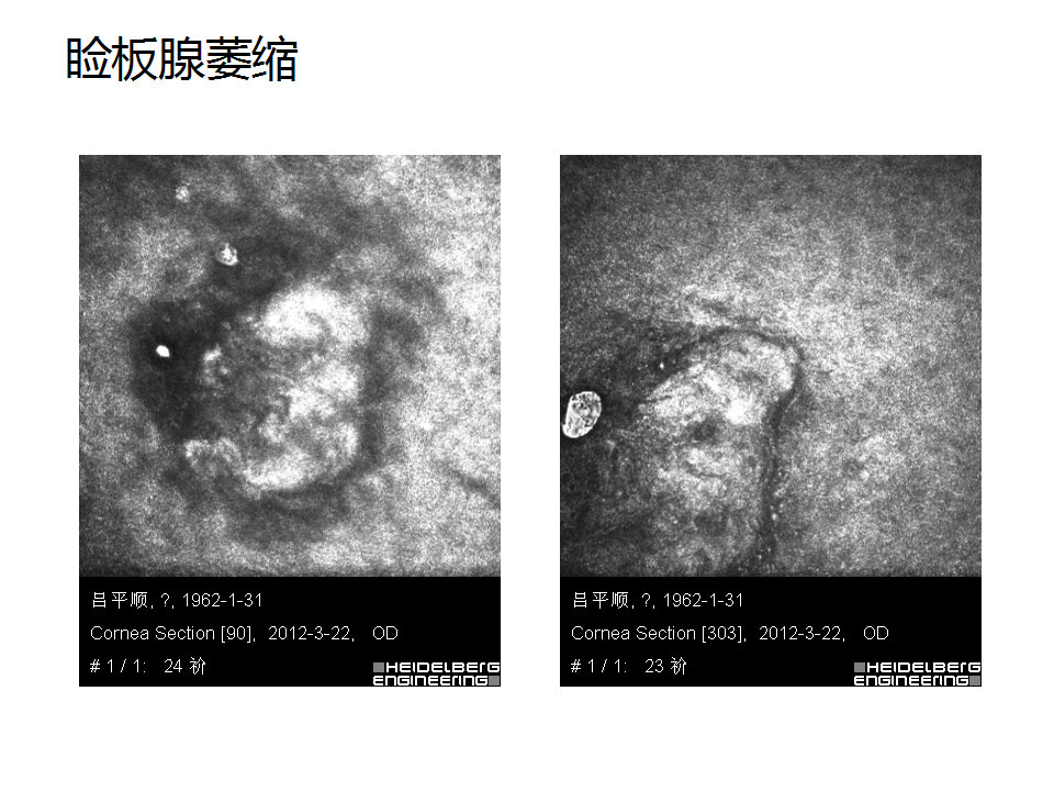 眼睑缘炎的发病原因,眼睑炎的症状和治疗方法