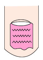 指甲竖纹里面有白点是什么原因,指甲有竖纹和白点是怎么回事