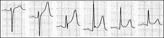 心电图st段抬高0.05mv是什么意思,心电图st段抬高但心脏彩超都正常
