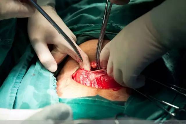 剖腹产恢复很好的照片,剖腹产完全恢复照片