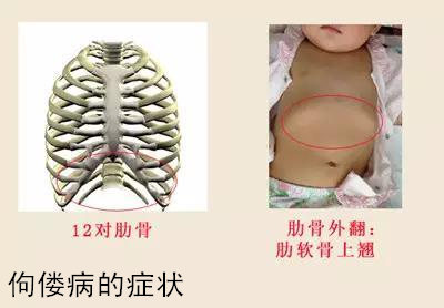 宝宝有严重佝偻病怎么办,宝宝佝偻病严重了怎么办