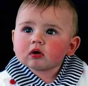 宝宝皮肤干裂怎么护肤,宝宝湿疹皮肤干燥用什么护肤霜